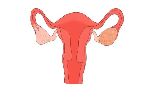 3 common jobs are associated with increased risk of ovarian cancer