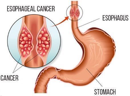 Eesophageal cancer: Keytruda+ chemotherapy will be approved in EU