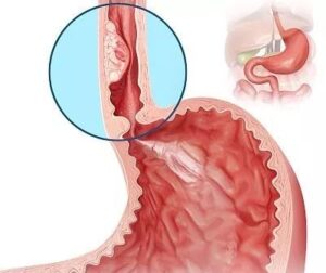 Esophageal cancer: Causes Symptoms Examination and Prevention