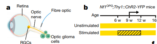Neurofibromatosis type 1 gene mutation promotes growth of optic neuroma
