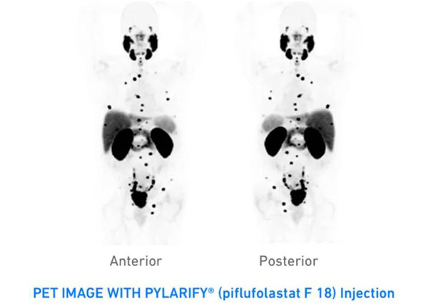 PET imaging agent Pylarify accurately detects prostate cancer
