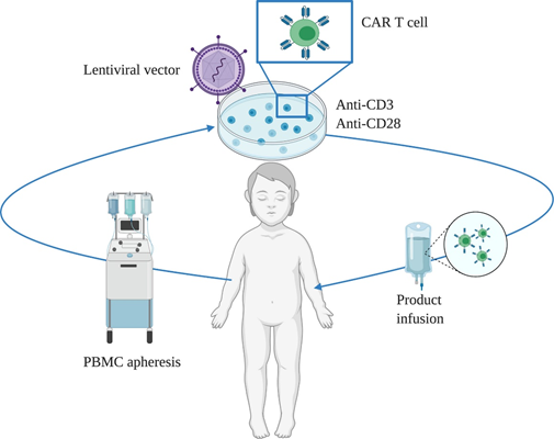 CAR-T cell therapy for pediatric acute lymphoblastic leukemia