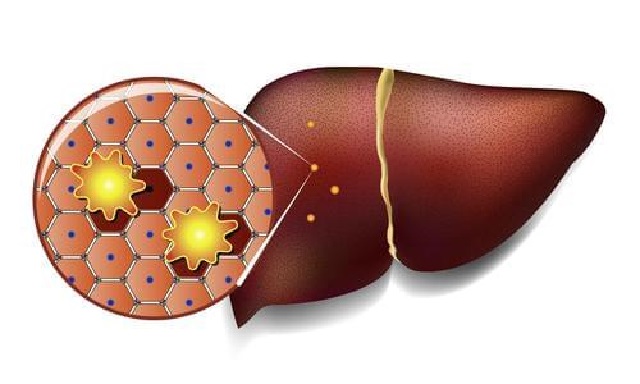 Can fatty liver get better if you insist on not eating meat?