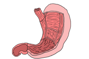 Why does bile reflux get worse and develop into gastric cancer?