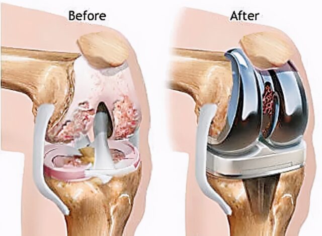 What knowledge should you understand before Joint replacement surgery? 