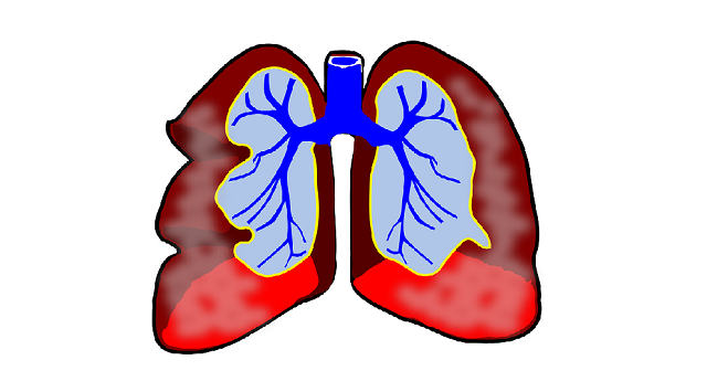 Will a lung cancer patient get the 2nd primary lung cancer again?