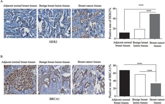 Her2 Breast Cancer: BRCA1 expression and radiotherapy sensitivity