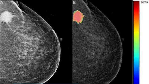 Statins may significantly improve the overall survival rate of breast cancer