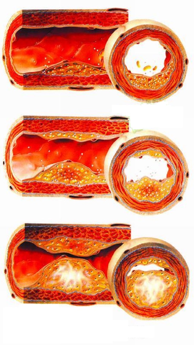 What is the difference between Arteriosclerosis and Atherosclerosis?