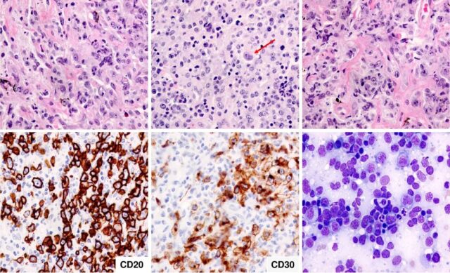 BLOOD reviews: Primary mediastinal large B-cell lymphoma.  PMBCL can also invade the CNS when it recurs.