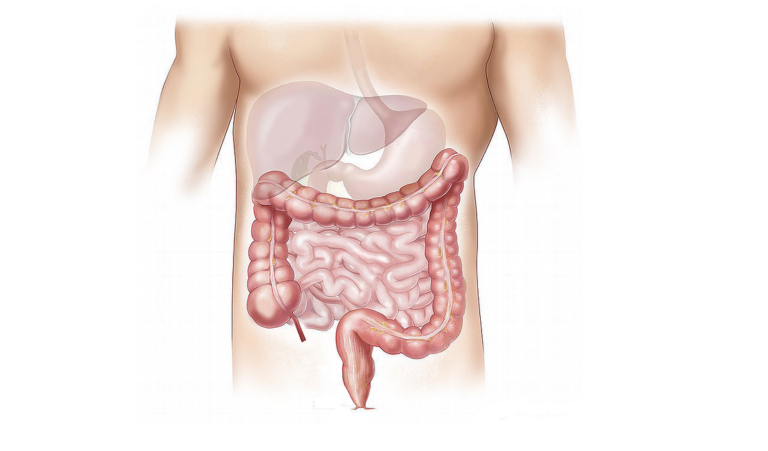 Why is colonoscopy recommended for prevention of colon cancer?