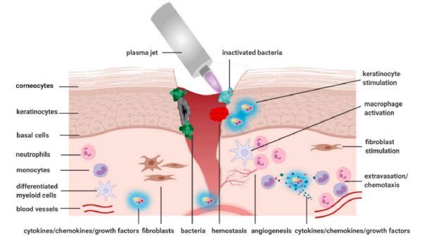 Medical gas plasma stimulates wound healing:  Evidence and Mechanism?