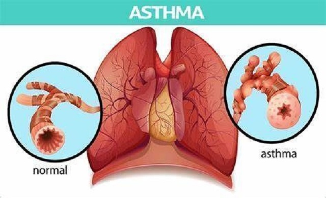 AstraZeneca new medicine for asthma: PT027 Phase-3 trials success. 