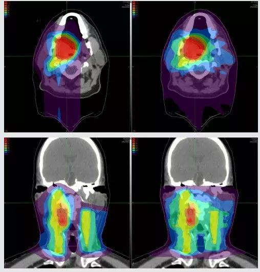 Proton therapy is the first choice for Head and neck tumors?