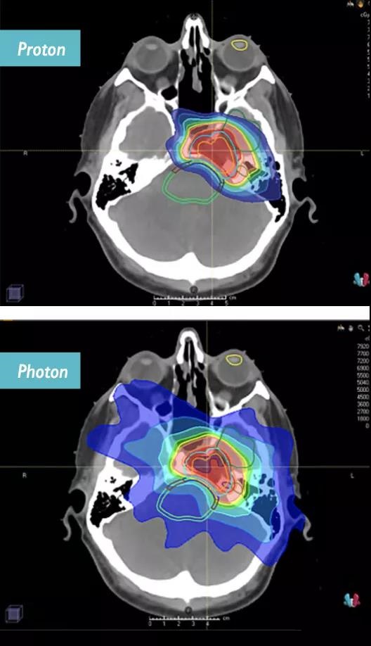 Proton therapy treat Skull base tumors by accurately blasting cancer cells
