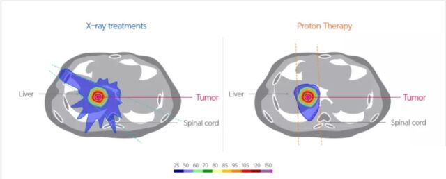 What cancer patients is the proton therapy suitable to?
