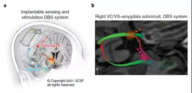 Implanting a "pacemaker" in the brain to successfully cure major depression through electrical stimulation