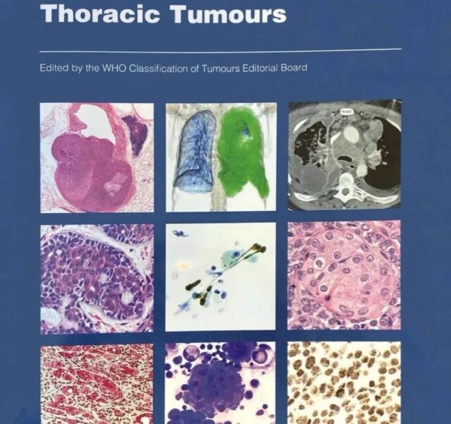 New WHO 2021 classification: Lung adenocarcinoma in situ was excluded from lung malignant tumors