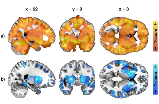 The person's brain had changed before becoming obese