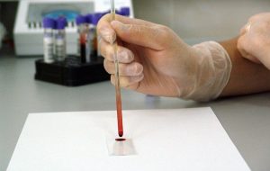 2022丨Breakthrough in blood testing may promote the diagnosis of Alzheimer's disease and Parkinson's disease