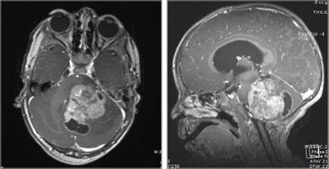 What is the difference between adult and childhood Diffuse gliomas?