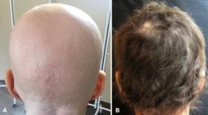FDA approves oral JAK inhibitor baricitinib for the treatment of alopecia areata