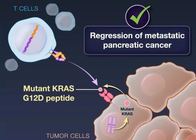 New breakthrough in the treatment of pancreatic cancer: The tumor shrank by 72%