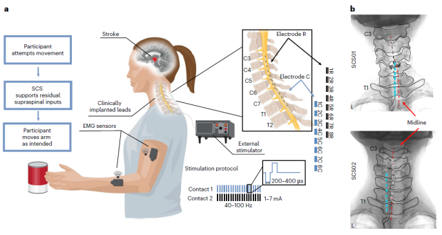 Nature Medicine: Electrical stimulation of the spinal cord aids upper limb rehabilitation in stroke patients