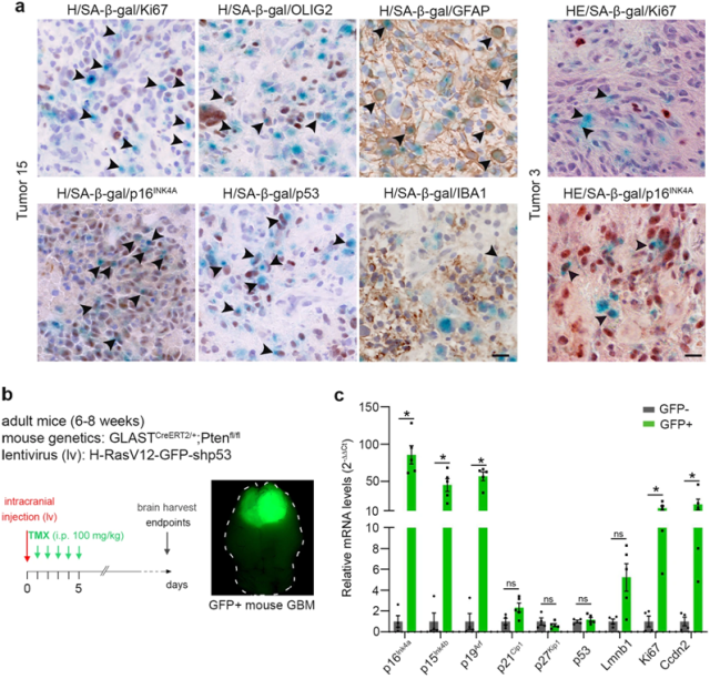 Senescent cells actually promote glioblastoma progression