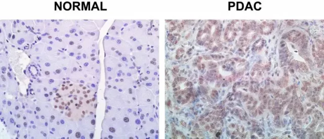 This killer protein leads to pancreatic cancer
