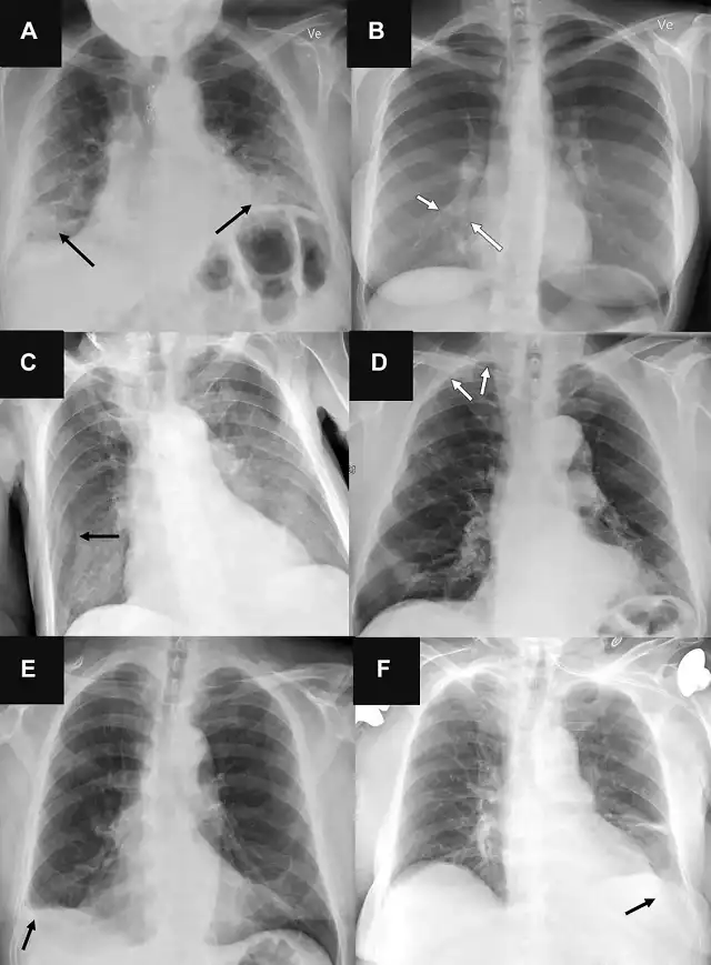 Radiologists Outperform AI in Identifying Lung Diseases on Chest X-Rays