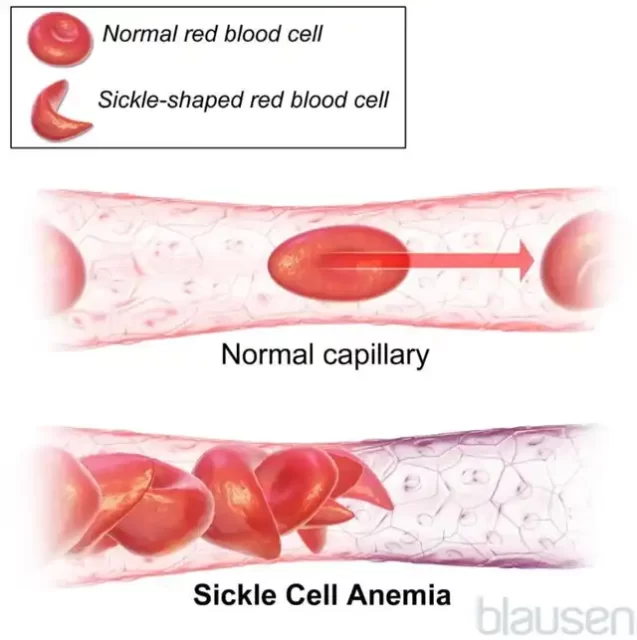 First CRISPR Gene Editing Therapy Nears FDA Approval for Sickle Cell Disease Treatment