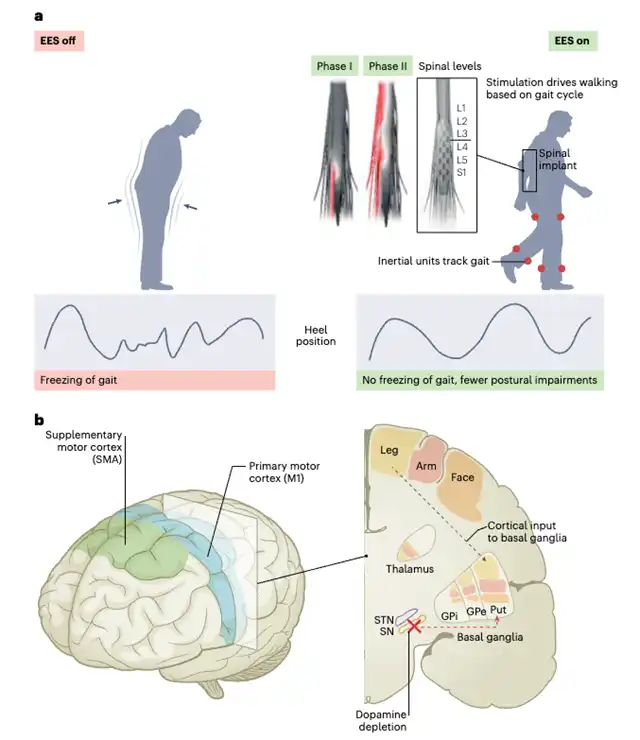 Nature Medicine: Implanting Neural Prostheses Improves Mobility in Parkinson's Disease Patients of 30 Years