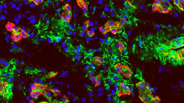 Researchers Discover Pancreatic Cancer Triggers Immune Response Contradicting Previous Views