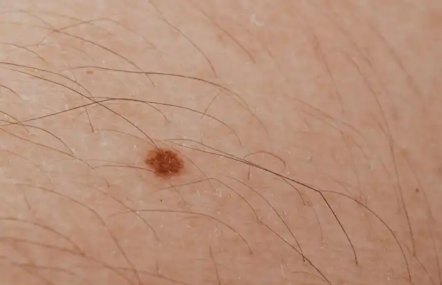 Why are "Mole Hairs" Not Recommended to Pluck?