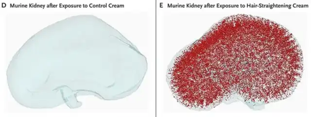 Hair straightening cream led to three episodes of acute kidney injury in two years