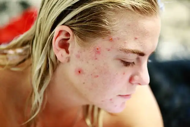 The Shadow Over Clear Skin: Can Acne Treatment Turn Carcinogen?