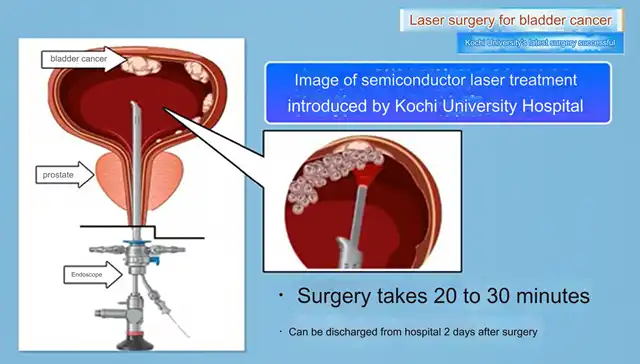 Kochi University pioneers outpatient bladder cancer treatment using semiconductor lasers