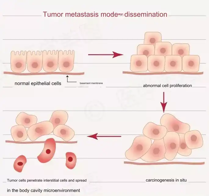 How Do Cancer Cells Metastasize?